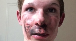 an-e-cigarette-exploded-in-an-alberta-teens-face-body-image-1453998844