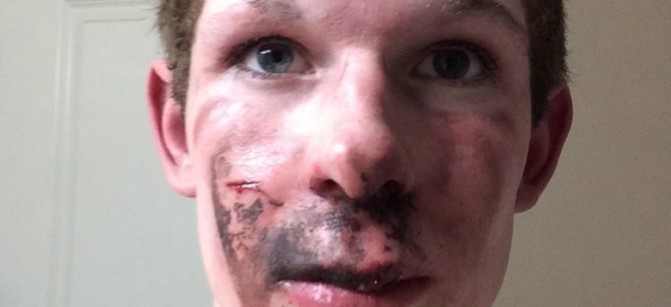 an-e-cigarette-exploded-in-an-alberta-teens-face-body-image-1453998844