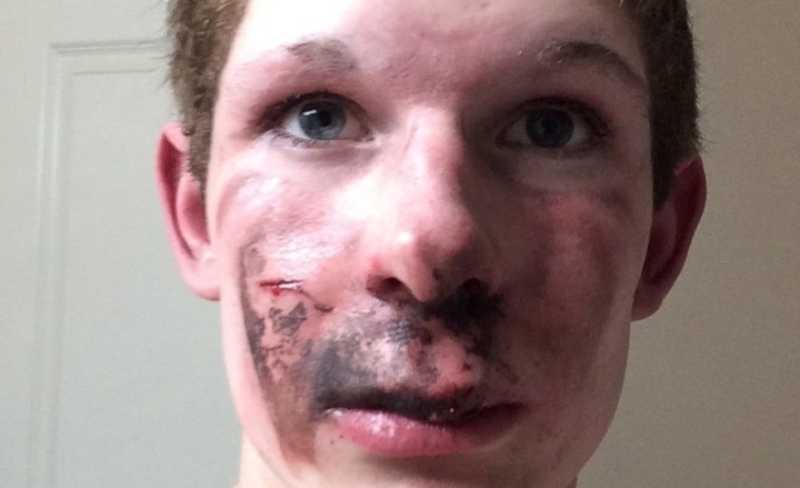 an-e-cigarette-exploded-in-an-alberta-teens-face-body-image-1453998844
