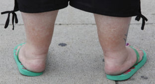 Eine uebergewichtige Frau steht am Mittwoch, 22. Juli 1009, am Alexanderplatz in Berlin. Fettleibigkeit, im Medizinischen Adipositas genannt, gilt als Volkskrankheit. (AP Photo/Franka Bruns)
---An obese woman visits Alexanderplatz in Berlin, Wednesday, July 22, 2009. (AP Photo/Franka Bruns)